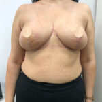 Коррекция асимметрии груди - после