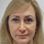 Нижняя блефаропластика - после