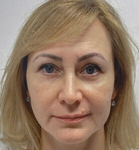 Нижняя блефаропластика - после