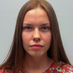 Нижняя блефаропластика - после