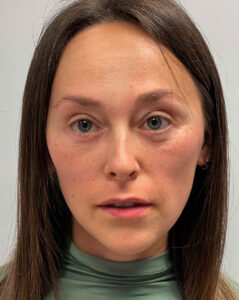 Нижняя блефаропластика - после