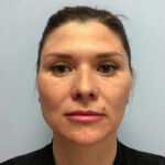 Нижняя блефаропластика - после