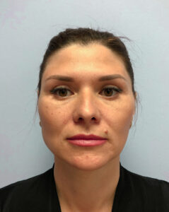 Нижняя блефаропластика - после