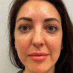 Нижняя блефаропластика - после