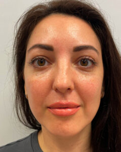 Нижняя блефаропластика - после