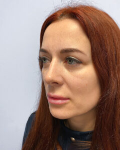 Верхняя блефаропластика - после