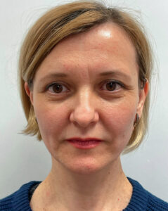 Верхняя блефаропластика - после