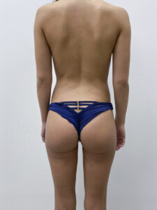 Липосакция - после