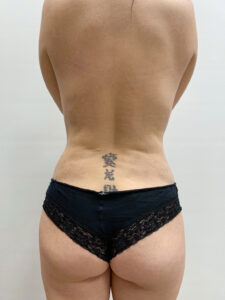 Липосакция - после