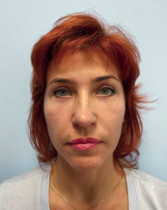 Круговая блефаропластика - после