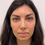 Круговая блефаропластика - после