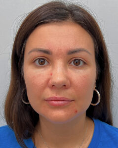 Круговая блефаропластика - после