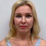 Круговая блефаропластика - после