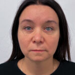 Круговая блефаропластика - после