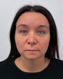 Круговая блефаропластика - после