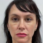 Верхняя блефаропластика - после