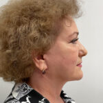 СМАС лифтинг - после