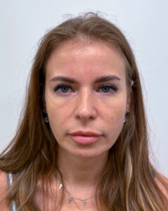 Верхняя блефаропластика - после