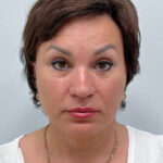 Смас с круговой блефаропластикой - после