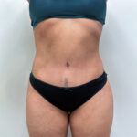 Абдоминопластика - после