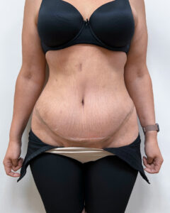 Абдоминопластика - после