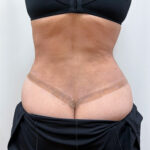 Липосакция с абдоминопластикой - после