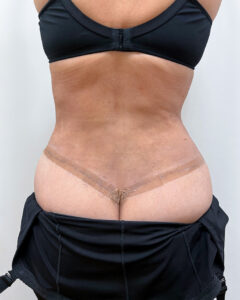 Липосакция с абдоминопластикой - после