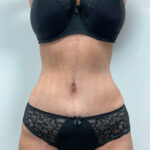 Абдоминопластика - после