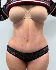 Абдоминопластика - после