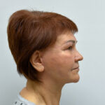 Тотальное омоложение - после