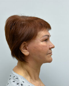 Тотальное омоложение - после