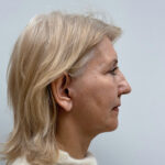 СМАС лифтинг - после