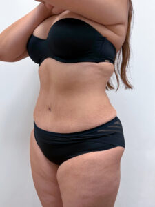 Липосакция - после