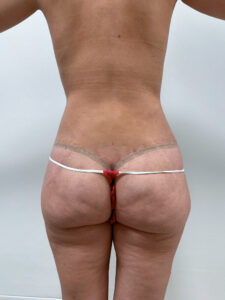 Липосакция - после