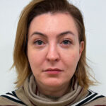 Блефаропластика и эндоскопический лифтинг - после