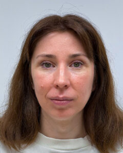 Верхняя блефаропластика с эндоскопическим лифтингом - после