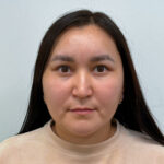 Верхняя блефаропластика с эндоскопическим лифтингом - после