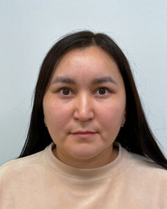 Верхняя блефаропластика с эндоскопическим лифтингом - после