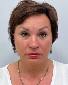 Эндоскопический лифтинг с круговой блефаропластикой - после