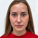 Трансконъюнктивальная блефаропластика - после