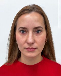 Трансконъюнктивальная блефаропластика - после