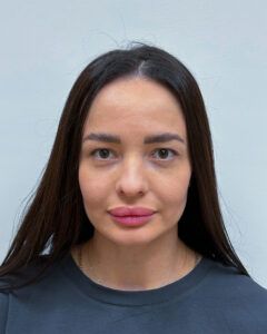 Трансконъюнктивальная блефаропластика - после