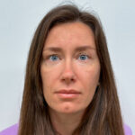 Трансконъюнктивальная блефаропластика - после