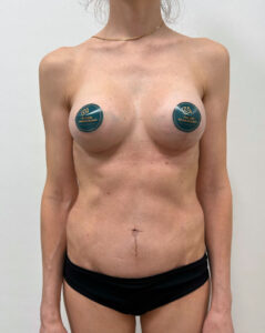 Маммопластика подтяжка - после