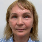 Тотальное омоложение лица - после