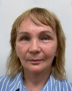 Тотальное омоложение лица - после