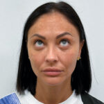 Нижняя блефаропластика - после