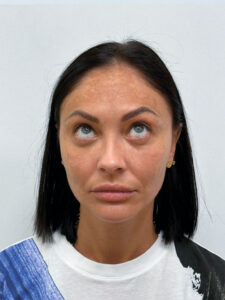 Нижняя блефаропластика - после