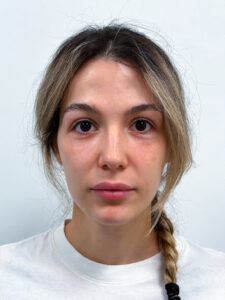 Нижняя блефаропластика - после