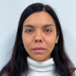 Нижняя блефаропластика - после